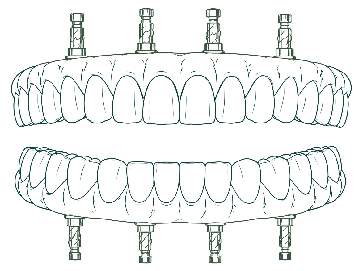 Full arch upper and lower implant restoration illustration