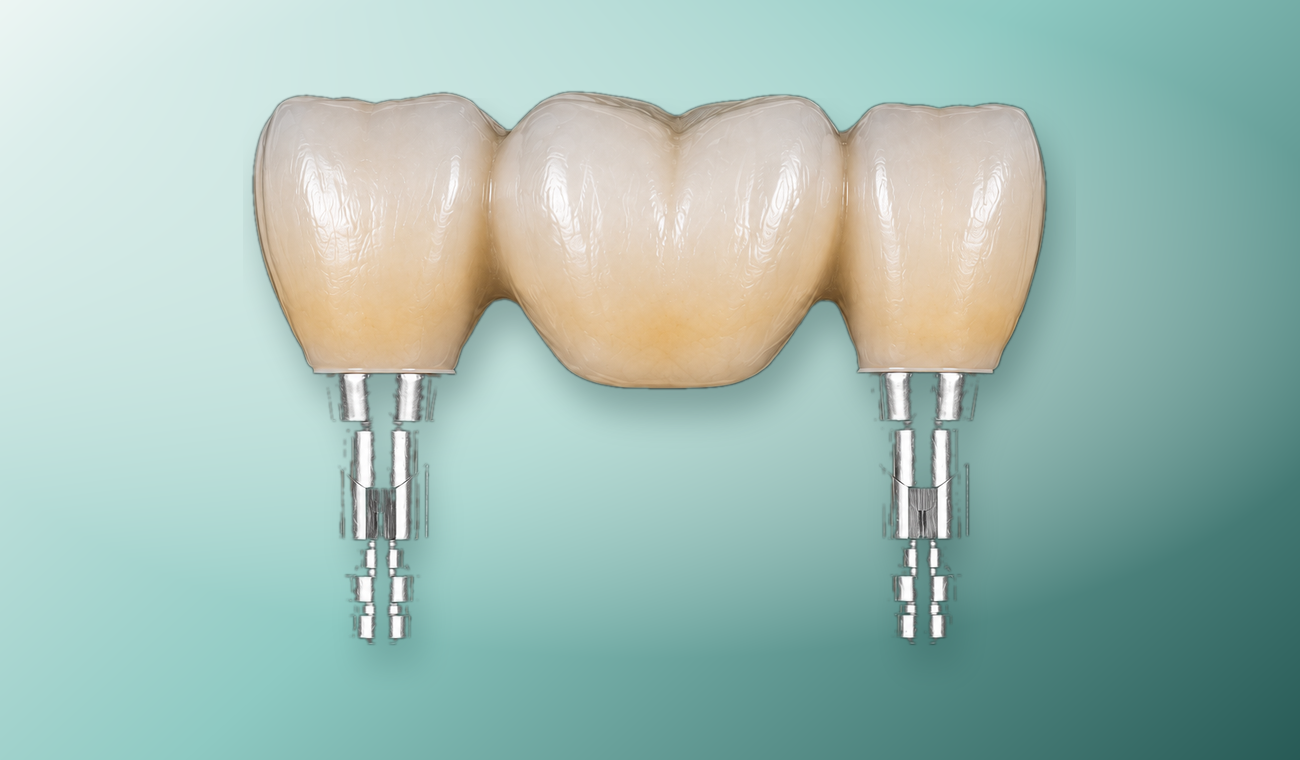 Multi-unit dental bridge product