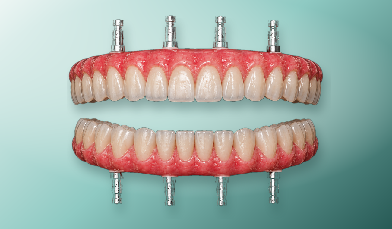 Full arch dental restoration product